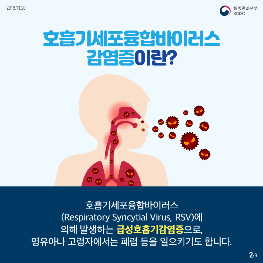 두번째 그림입니다.
호흡기세포융합바이러스감염증이란? 호흡기세포융합바이러스(Respiratory Syncytial Virus, RSV)에 의해 발생하는 급성호흡기감염증으로, 영유아나 고령자에서는 폐렴 등을 일으키기도 합니다. 사진1